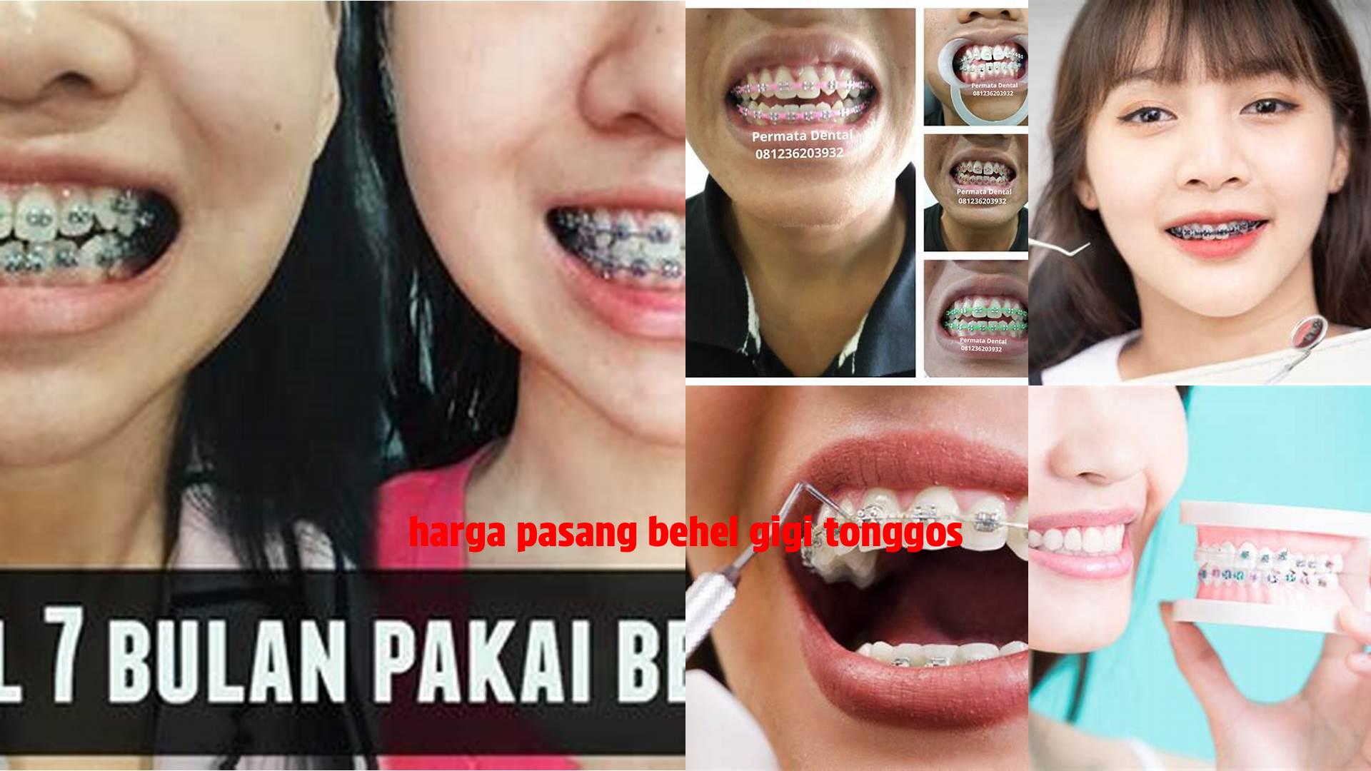 Panduan Lengkap Harga Pasang Behel Gigi Tonggos