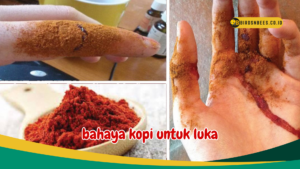 bahaya kopi untuk luka