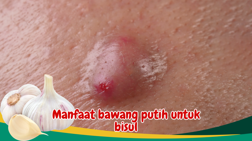 Manfaat bawang putih untuk bisul